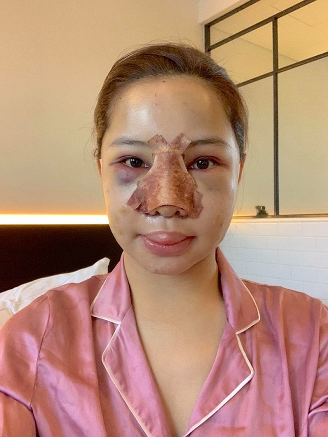 Lưu Đê Ly trải qua cuộc đại phẫu gồm hạ gò má, nâng mũi, sửa cằm, căng chỉ da mặt, cấy mỡ tự thân