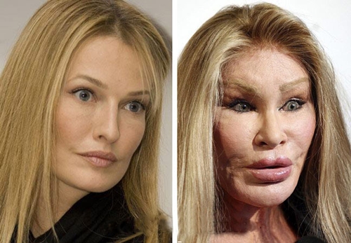 Jocelyn Wildenstein phẫu thuật thẩm mỹ quá đà dẫn đến biến dạng khuôn mặt