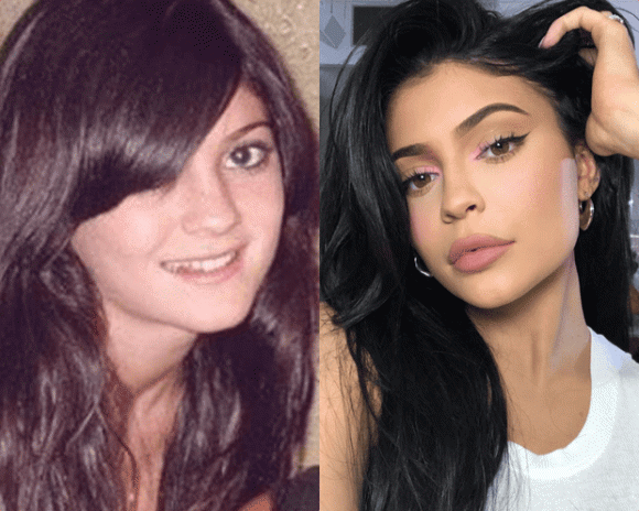 Kylie Jenner ảnh quá khứ và hiện tại thật sự có nhiều điểm khác biệt vì vậy cô nàng từng bị nghi phẫu thuật thẫm mỹ. Điểm khác biệt dễ nhìn ra là trước đây Kylie có gương mặt bụ bẫm, đôi môi mỏng và hàm răng không đều.
