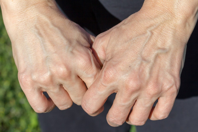 Lượng mỡ dưới da thấp do gầy là một trong những nguyên nhân gây nổi gân tay và chân.