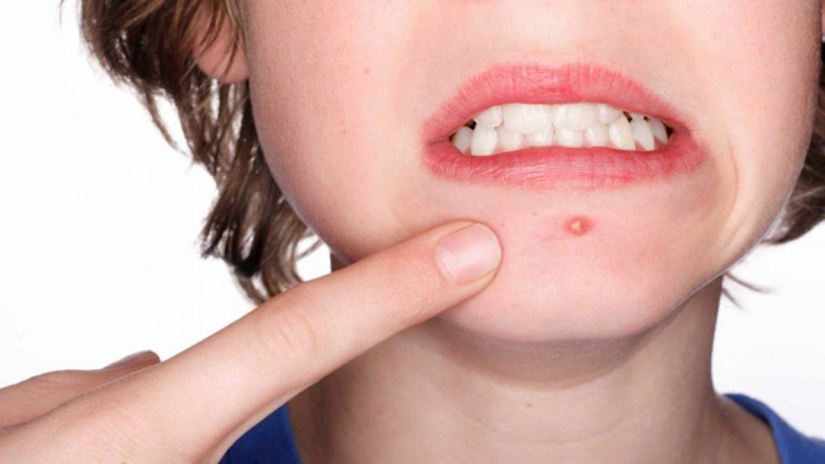 Bí kíp nặn mụn đúng cách, không để lại thâm ai cũng cần biết