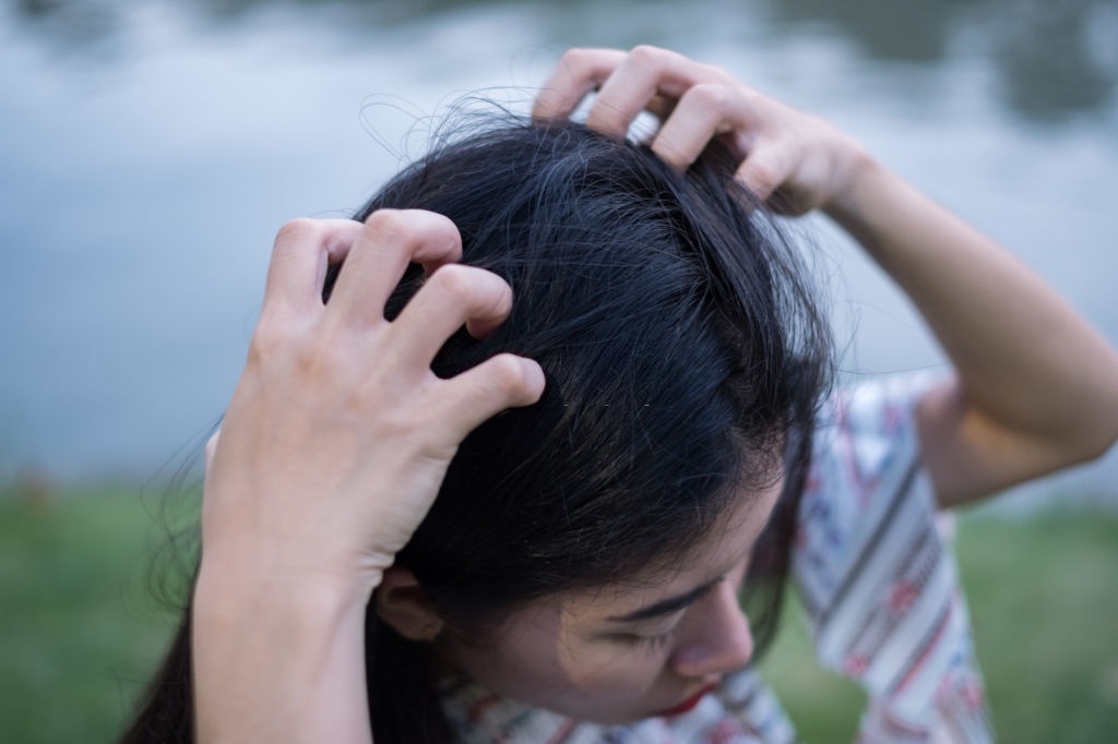 Tuyệt chiêu giúp tóc bớt gàu trong mùa hè