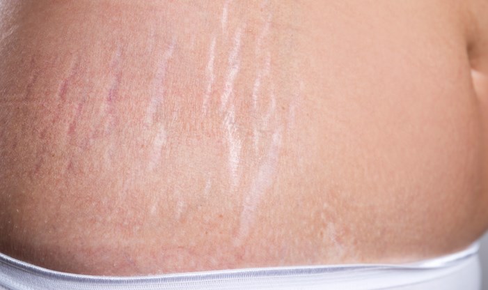 Các vết rạn da thường gặp ở phụ nữ sau sinh...