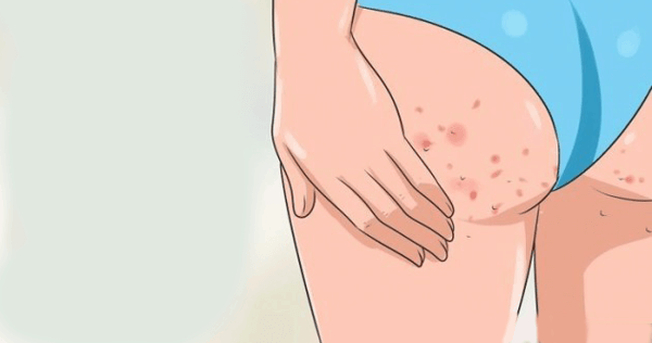 Nguyên nhân và cách phòng ngừa mụn mông hiệu quả