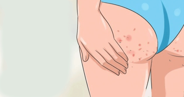 Nguyên nhân gây ra mụn mông là do các nang lông bị nhiễm trùng.