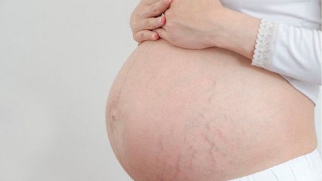 Rạn da khi mang thai thường do tăng cân.