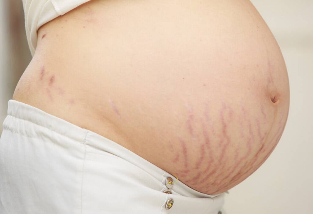 Rạn da khi mang thai hầu như ai cũng gặp phải.