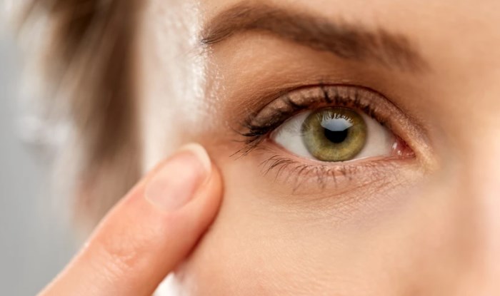 Da khô quanh mắt có thể được điều trị bằng một số cách tự nhiên.
