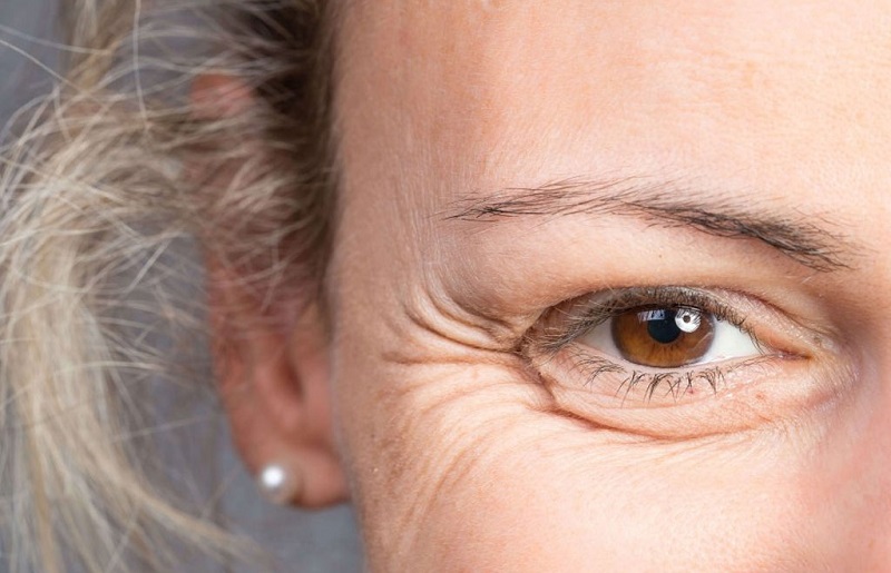 Nguyên nhân gây ra vết chân chim và cách ngăn ngừa