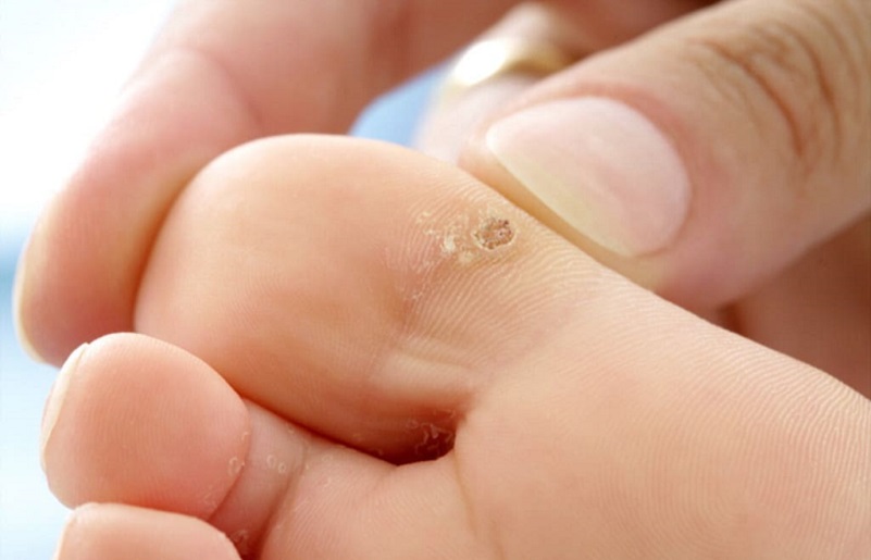 4 cách trị mụn cóc đơn giản, hiệu quả nhanh chóng
