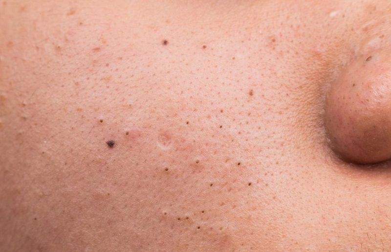 Cách trị mụn đầu đen hiệu quả từ chuyên gia da liễu
