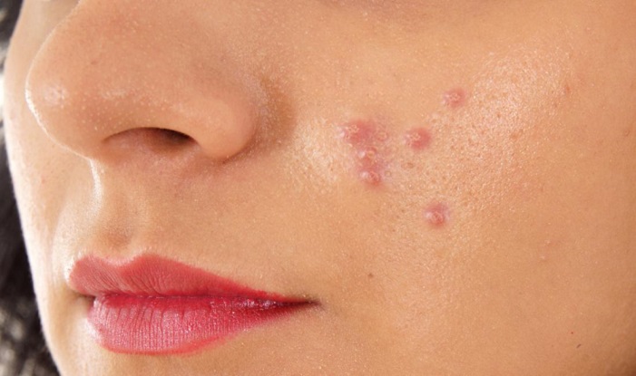 Cách trị mụn mủ: Sai một li, đi một dặm