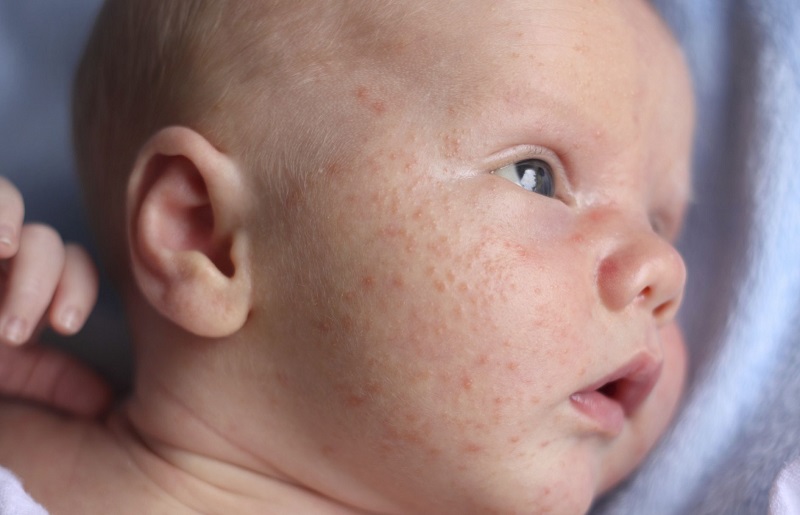 Cách trị mụn sữa ở trẻ sơ sinh các mẹ cần biết