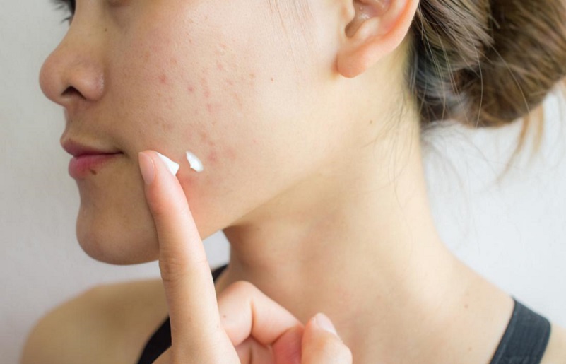 4 cách trị mụn thâm tại nhà hiệu quả giúp làn da sạch mụn, đều màu