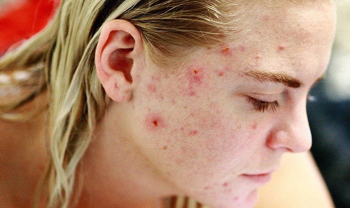 Cách trị mụn nội tiết tố bằng cách điều chỉnh chế độ ăn uống