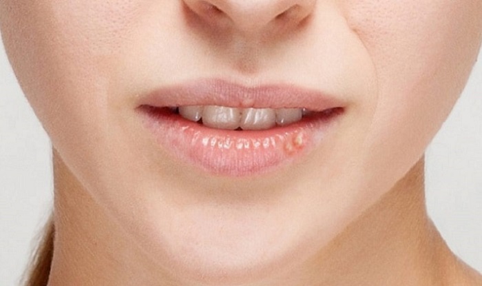 Môi xinh mọc mụn: Đâu là cách trị mụn ở môi nhanh nhất