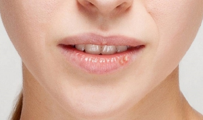 Có vài nguyên nhân gây ra mụn môi.