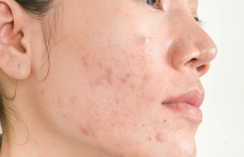 Chăm sóc da mụn tại nhà hiệu quả nhờ những công thức này