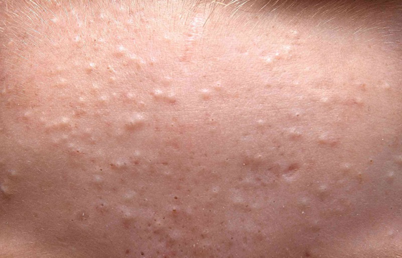 Bạn đã biết những cách trị mụn ẩn tại nhà này chưa?