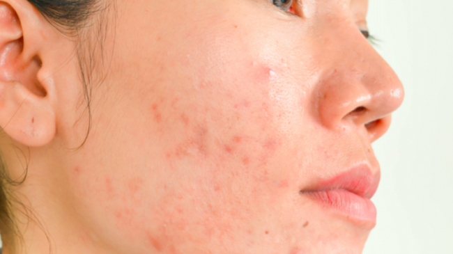 Bỏ túi những cách trị mụn viêm sưng đỏ cực kỳ hiệu quả