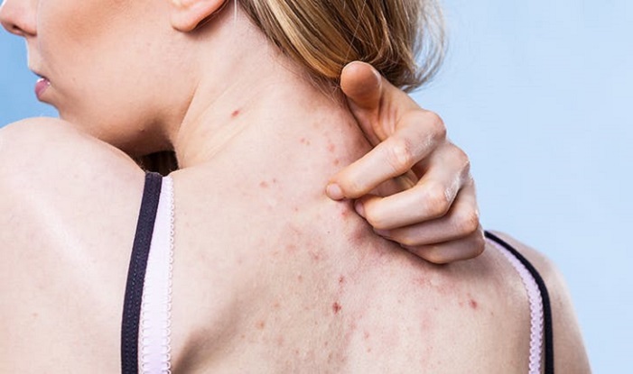 Cách trị mụn sau lưng hiệu quả từ các chuyên gia