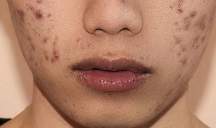 Nên ăn gì để hết thâm mụn hiệu quả?