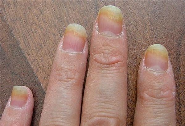 Sơn móng tay nhiều có thể khiến móng tay bị giòn và mắc các loại nấm