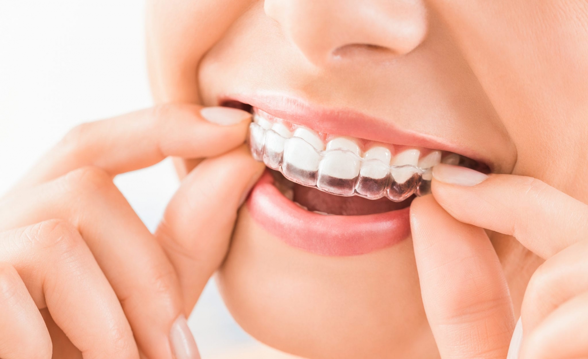 Niềng răng invisalign là phương pháp tân tiến nhất hiện nay
