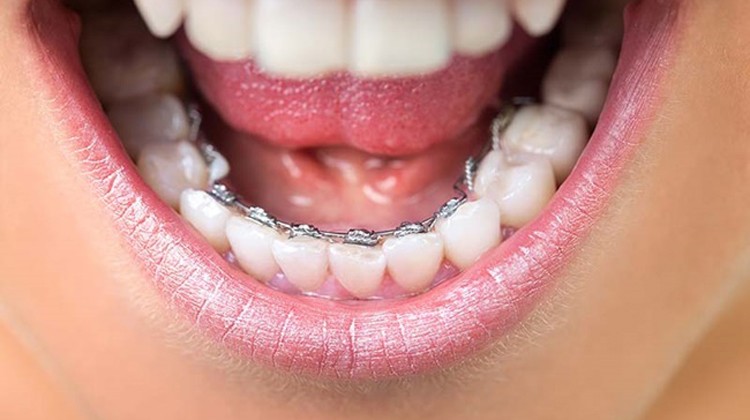 Sẽ không ai biết bạn đang niềng răng vì những mối niềng được gắn vào mặt trong của răng.