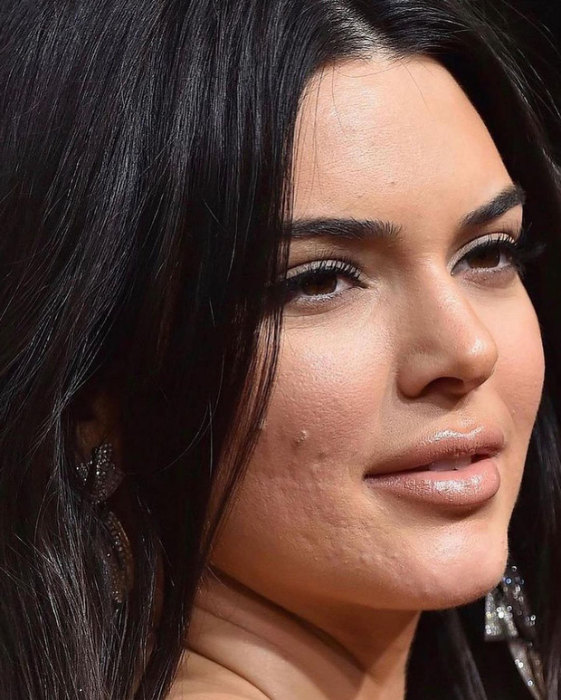 Phần da dưới gò má và ở gần xương hàm của Kendall Jenner nổi mụn chi chít, sần sùi. Trong khi đó các vị trí khác trên da cô khá mịn màng. Đây là thời kỳ tồi tệ nhất của làn da Kylie Jenner. Bây giờ, cô nàng đã tiết chế trang điểm hơn nhiều nên làn da cũng đẹp hơn thời điểm đó.