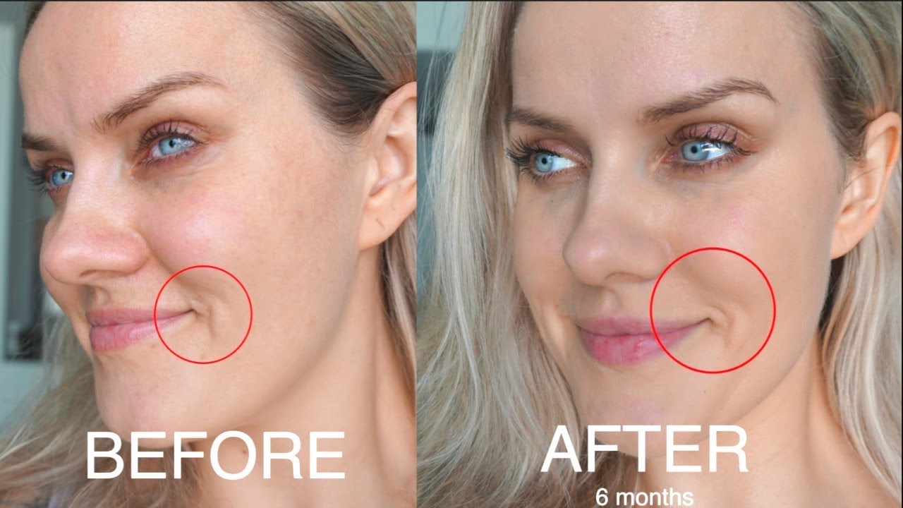 Hình ảnh so sánh tình trạng da trước và sau khi sử dụng công nghệ Thermage