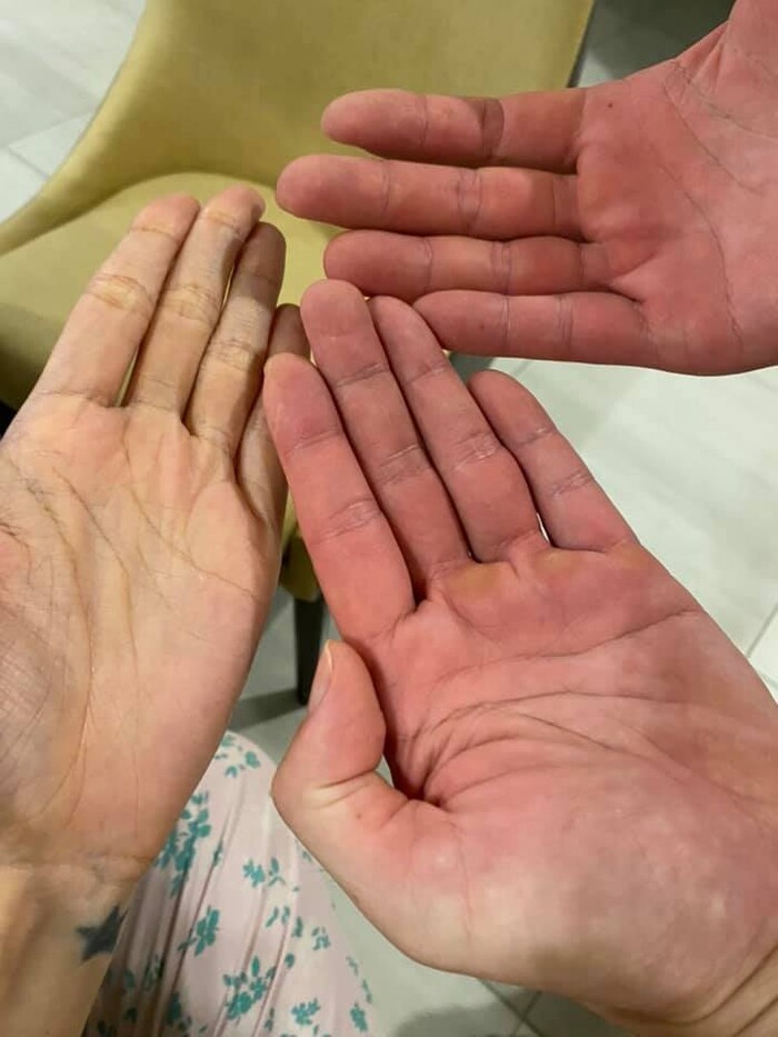 Bàn tay đỏ ứng của Công Vinh khi phụ giúp vợ làm thiện nguyện