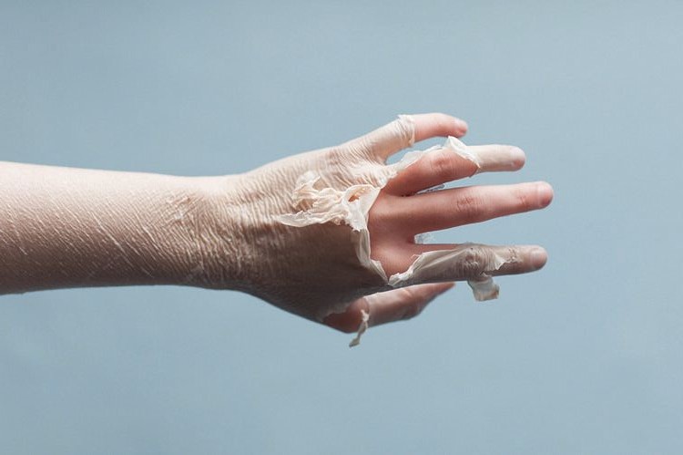 Suy nghĩ mùa đông không cần kem chống nắng là một sai lầm