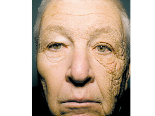 Khuôn mặt của người tài xế xe tải bị lão hóa một bên do tác hại từ ánh nắng mặt trời.-New England Journal of Medicine