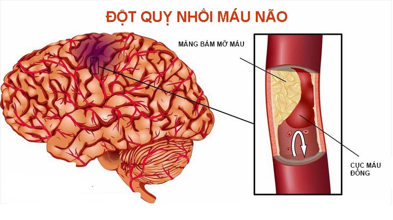 Dấu hiệu cảnh báo đột quỵ