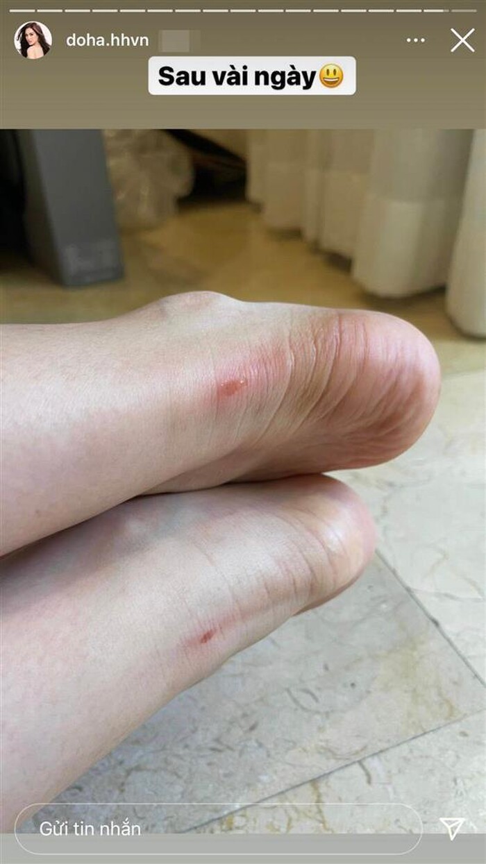 Đôi chân rớm máu của Hoa hậu Đỗ Thị Hà trước đó