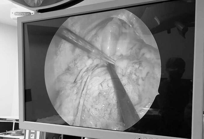 Hình ảnh toàn bộ ruột non chui qua lỗ thoát vị nằm trên khoang màng phổi trái. Ảnh: Bệnh viện cung cấp.