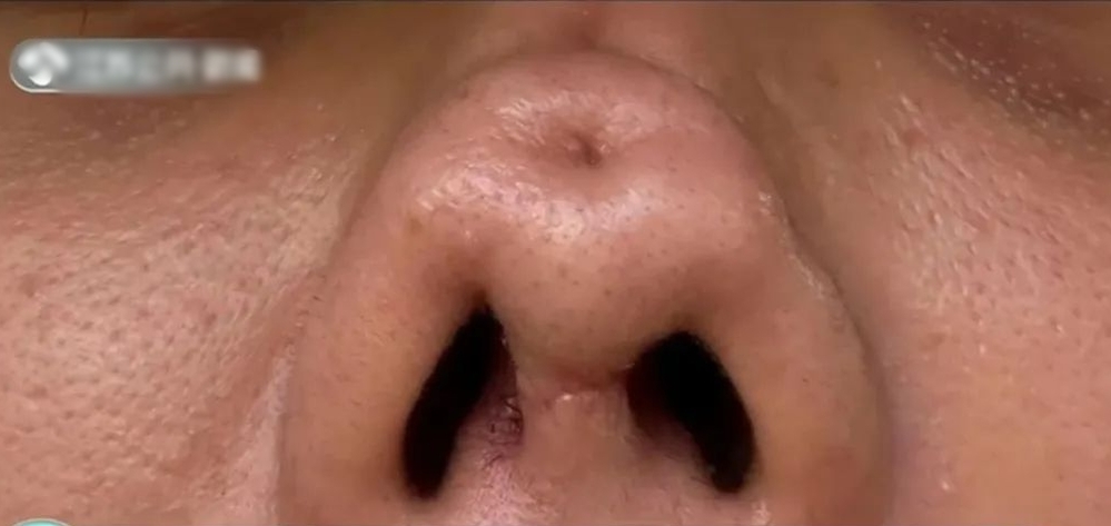 Người phụ nữ nhận lại chiếc mũi có tận 4 lỗ sau khi bỏ 70 triệu để thẩm mỹ - Ảnh 1