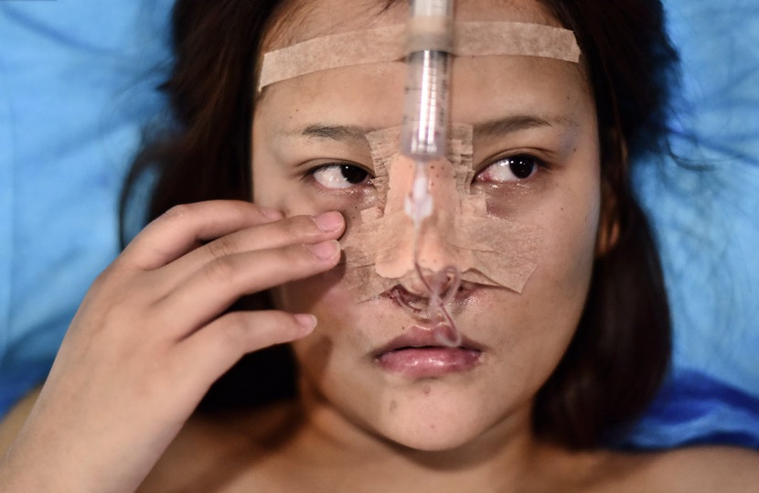Nhiều người trẻ Trung Quốc vay nợ tân trang nhan sắc cho giống trên mạng