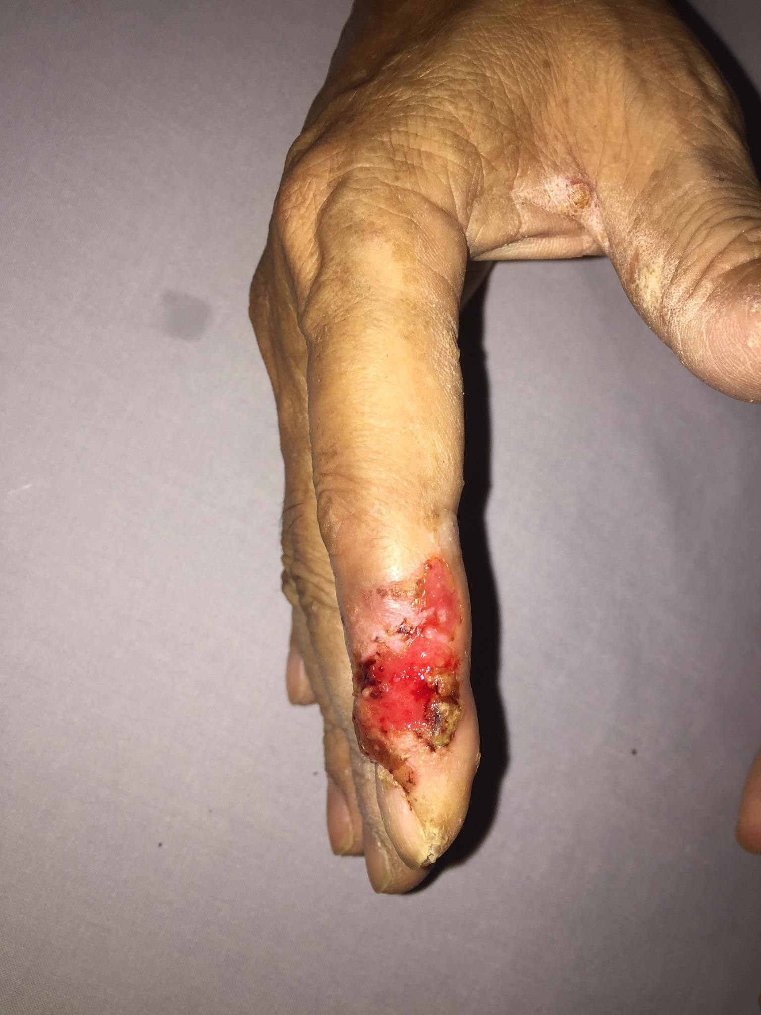 Bàn tay nam bệnh nhân bị ung thư da với những vết loét đỏ, chảy dịch