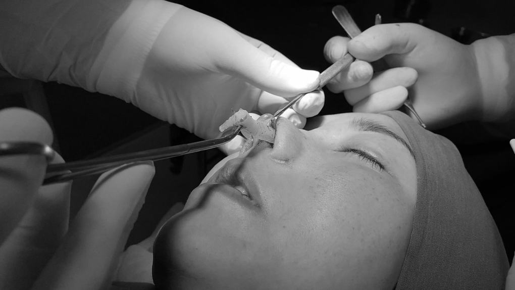 Bác sĩ phẫu thuật xử lý chiếc mũi bị hoại tử của bệnh nhân.
