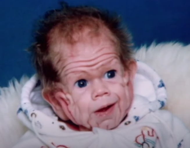 Tomm là đứa bé đầu tiên trên thế giới sinh ra với làn da chảy xệ.