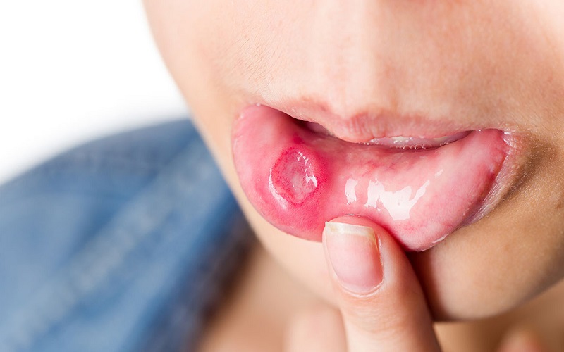 Nhiệt miệng thường xuyên có phải do nóng trong?