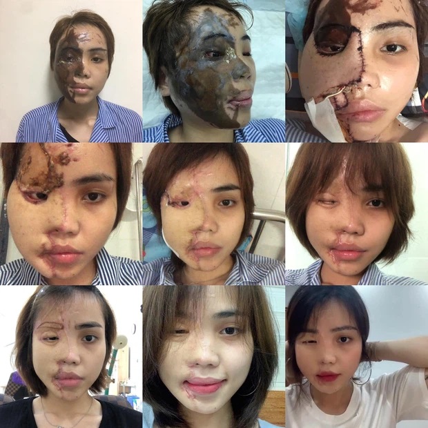Lan Vy phải trải qua 16 cuộc phẫu thuật để khôi phục gương mặt sau khi bị tạt axit