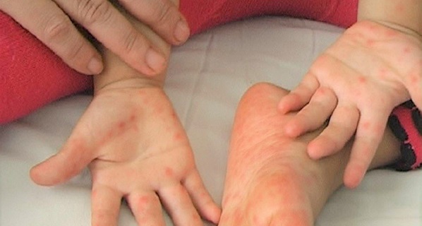 Dấu hiệu nhận biết và cách phòng tránh bệnh tay chân miệng