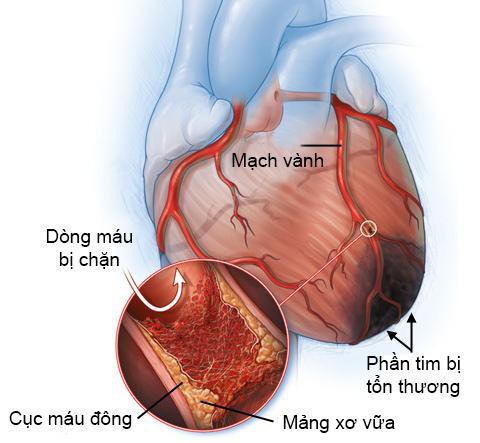 Hoa hậu Thu Thủy qua đời: Bác sĩ tim mạch lý giải nguyên nhân - Ảnh 3