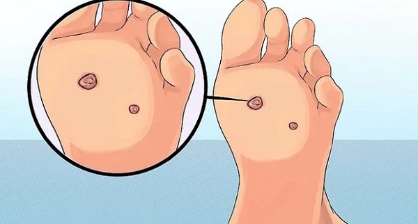 Dấu hiệu điển hình ở chân cảnh báo nguy cơ mắc ung thư cổ tử cung