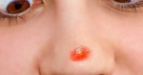 Nặn mụn ở vùng 'tam giác chết' trên mặt có thể gây nhiễm trùng não