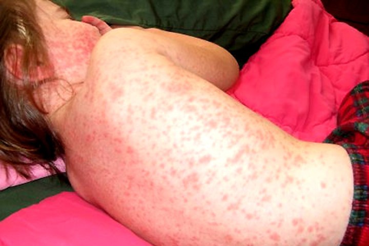 BS khuyến cáo: Trẻ mắc sốt xuất huyết hết sốt ngày thứ 4 có thể là dấu hiệu chuyển nặng - Ảnh 1