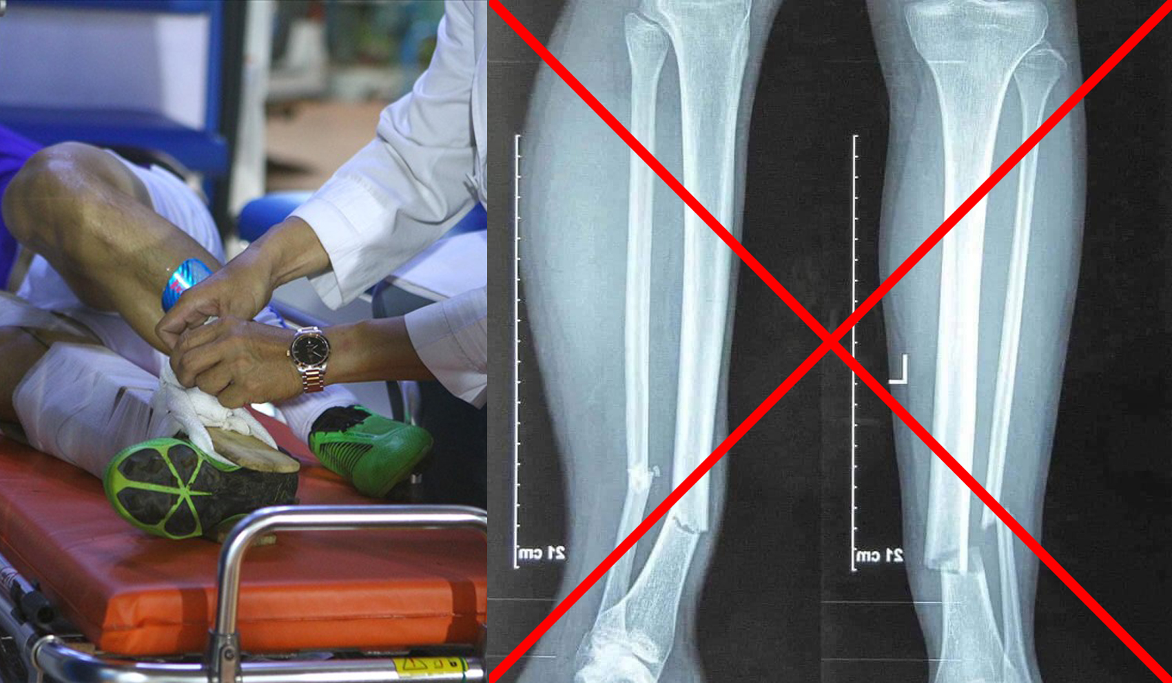 Thực hư về ảnh chụp X-quang chân của Hùng Dũng và chuyện thầy Park đập vỡ điện thoại trong bệnh viện